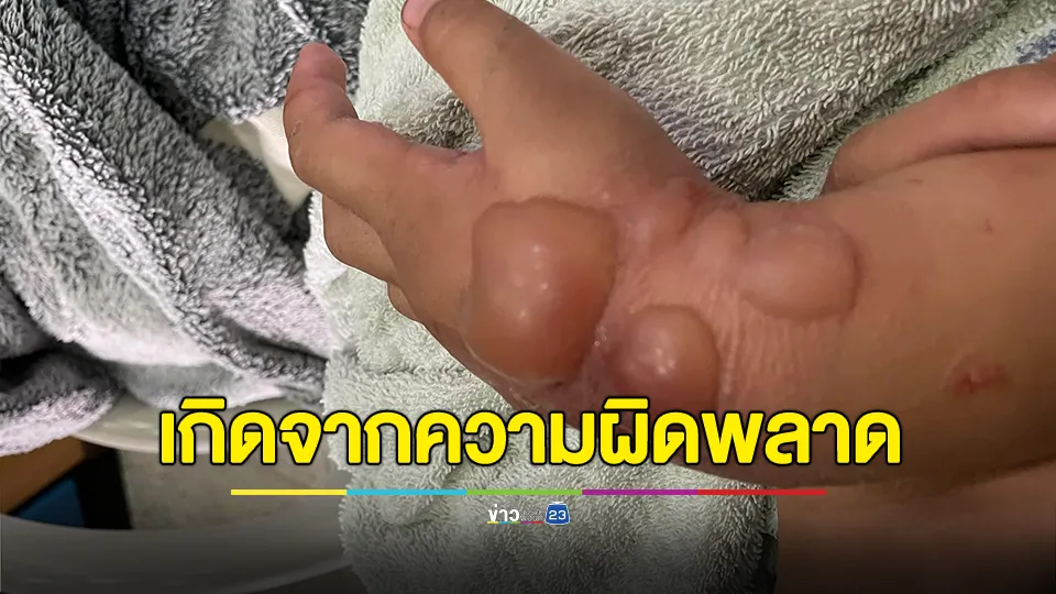 พยาบาลฉีดน้ำเกลือจนทำให้แขนเด็กมีตุ่มน้ำใสพองขนาดใหญ่ 